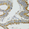 Immunohistochemistry of paraffin-embedded Human colon carcinoma using MT-ND5 Polyclonal Antibody at dilution of  1:100 (40x lens).