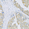 Immunohistochemistry of paraffin-embedded Human liver cancer using ARFGAP3 Polyclonal Antibody at dilution of  1:100 (40x lens).