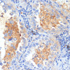 Immunohistochemistry of paraffin-embedded Human lung cancer using SEMA4C Polyclonal Antibody at dilution of  1:100 (40x lens).