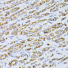 Immunohistochemistry of paraffin-embedded Human colon carcinoma using CCDC92 Polyclonal Antibody at dilution of  1:100 (40x lens).