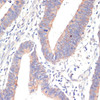 Immunohistochemistry of paraffin-embedded Human colon carcinoma using WNT5B Polyclonal Antibody at dilution of  1:100 (40x lens).