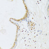 Immunohistochemistry of paraffin-embedded Human breast cancer using ANKRD52 Polyclonal Antibody at dilution of  1:100 (40x lens).