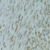 Immunohistochemistry of paraffin-embedded Human uterine cancer using GABPA Polyclonal Antibody at dilution of  1:100 (40x lens).
