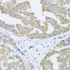 Immunohistochemistry of paraffin-embedded Human liver cancer using TIMM10B Polyclonal Antibody at dilution of  1:100 (40x lens).