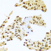 Immunohistochemistry of paraffin-embedded Human lung cancer using SMEK1 Polyclonal Antibody at dilution of  1:100 (40x lens).