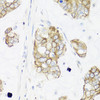 Immunohistochemistry of paraffin-embedded Human gastric cancer using IER3 Polyclonal Antibody at dilution of  1:100 (40x lens).