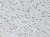 Immunohistochemistry of paraffin-embedded Human uterine cancer using HDGFRP3 Polyclonal Antibody at dilution of  1:100 (40x lens).