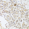 Immunohistochemistry of paraffin-embedded Human lung cancer using RNASEL Polyclonal Antibody at dilution of  1:100 (40x lens).
