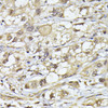 Immunohistochemistry of paraffin-embedded Human liver cancer using PSMB3 Polyclonal Antibody at dilution of  1:100 (40x lens).