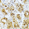 Immunohistochemistry of paraffin-embedded Human liver cancer using RRAGD Polyclonal Antibody at dilution of  1:100 (40x lens).