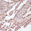 Immunohistochemistry of paraffin-embedded Human lung cancer using Phospho-ATF2(T71) Polyclonal Antibody at dilution of  1:100 (40x lens).