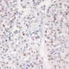 Immunohistochemistry of paraffin-embedded Human gastric cancer using Phospho-γH2A.X(S139) Polyclonal Antibody at dilution of  1:200 (40x lens).