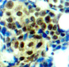 Immunohistochemistry of paraffin-embedded Human breast carcinoma tissue, using Phospho-MAPK3(T202) Polyclonal Antibody