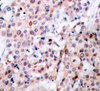 Immunohistochemistry of paraffin-embedded Human breast carcinoma tissue, using Phospho-Bcl-2(T56) Polyclonal Antibody