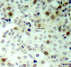 Immunohistochemistry of paraffin-embedded Human breast carcinoma using Phospho-CDK2(T160) Polyclonal Antibody