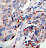 Immunohistochemistry of paraffin-embedded Human breast carcinoma tissue, using Phospho-JAK2(Y221) Polyclonal Antibody