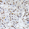 Immunohistochemistry of paraffin-embedded Human liver cancer using Phospho-ATF2(T69/T71) Polyclonal Antibody at dilution of  1:100 (40x lens).