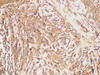 Immunohistochemistry of paraffin-embedded Human breast cancer using CHI3L1 Polycloanl Antibody at dilution of 1:300