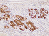 Immunohistochemistry of paraffin-embedded Human duodenal cancer using DMBT1 Polycloanl Antibody at dilution of 1:300