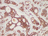 Immunohistochemistry of paraffinembedded Human prostate cancer tissue with AMACR/p504s Monoclonal Antibody(Antigen repaired by EDTA).