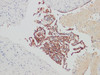 Immunohistochemistry of paraffinembedded Human ovarian cancer with CA-125 Monoclonal Antibody(Antigen repaired by EDTA).