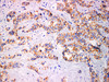 Immunohistochemistry of paraffinembedded Human breast cancer tissue with Cadherin pan Monoclonal Antibody(Antigen repaired by EDTA).