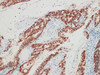 Immunohistochemistry of paraffinembedded Human colon cancer tissue with CDX-2 Monoclonal Antibody(Antigen repaired by EDTA).