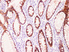 Immunohistochemistry of paraffinembedded Human colon cancer tissue with Claudin 7 Monoclonal Antibody(Antigen repaired by EDTA).