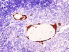 Immunohistochemistry of paraffinembedded Human lung squamous cell carcinoma with Cytokeratin 10 Monoclonal Antibody(Antigen repaired by EDTA).