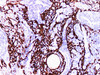 Immunohistochemistry of paraffinembedded Human lung squamous cell carcinoma with Cytokeratin 14 Monoclonal Antibody(Antigen repaired by EDTA).