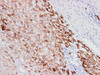 Immunohistochemistry of paraffinembedded Human liver cancer tissue with Cytokeratin 18 Monoclonal Antibody(Antigen repaired by EDTA).