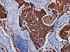 Immunohistochemistry of paraffinembedded Human lung squamous cell carcinoma with Cytokeratin Pan Monoclonal Antibody(Antigen repaired by EDTA).