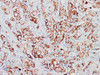 Immunohistochemistry of paraffinembedded Human breast cancer tissue with GCDFP-15 Monoclonal Antibody(Antigen repaired by EDTA).