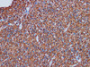 Immunohistochemistry of paraffinembedded Human glioma tissue with Glial Fibrillary Acidic Protein(GFAP) Monoclonal Antibody(Antigen repaired by EDTA).