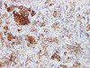 Immunohistochemistry of paraffinembedded Human pituitary tumor tissue with Human Growth Hormone(GH) Monoclonal Antibody(Antigen repaired by EDTA).
