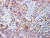 Immunohistochemistry of paraffinembedded Human breast cancer tissue with Mammaglobin Monoclonal Antibody(Antigen repaired by EDTA).