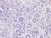 Immunohistochemistry of paraffinembedded Human gastric cancer tissue with Mast cell tryptase(MCT) Monoclonal Antibody(Antigen repaired by EDTA).