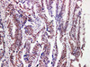 Immunohistochemistry of paraffinembedded Human colon cancer tissue with MutL Protein Homolog 1(MLH1) Monoclonal Antibody(Antigen repaired by EDTA).