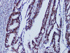 Immunohistochemistry of paraffinembedded Human colon cancer tissue with MutS Protein Homolog 6(MSH6) Monoclonal Antibody(Antigen repaired by EDTA).