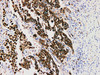 Immunohistochemistry of paraffinembedded Human lung adenocarcinoma with Napsin A Monoclonal Antibody(Antigen repaired by EDTA).