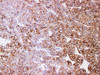 Immunohistochemistry of paraffinembedded Human liver cancer tissue with N-Cadherin Monoclonal Antibody(Antigen repaired by EDTA).