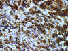 Immunohistochemistry of paraffinembedded Human pituitary tumor tissue with PRL Monoclonal Antibody(Antigen repaired by EDTA).