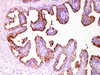Immunohistochemistry of paraffinembedded Human prostate cancer tissue with Prostate-Specific Membrane Antigen(PSMA) Monoclonal Antibody(Antigen repaired by EDTA).