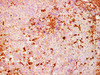 Immunohistochemistry of paraffinembedded Human melanoma tissue with S100A4 Monoclonal Antibody(Antigen repaired by EDTA).