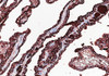 Immunohistochemistry of paraffinembedded Human thyroid tissue with Thyroglobulin(TG) Monoclonal Antibody(Antigen repaired by EDTA).