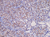 Immunohistochemistry of paraffinembedded Human thyroid  cancer tissue with Thyroid transcription factor-1(TTF1) Monoclonal Antibody(Antigen repaired by EDTA).