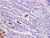 Immunohistochemistry of paraffinembedded Human lung adenocarcinoma with TRAP Monoclonal Antibody(Antigen repaired by EDTA).