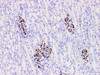 Immunohistochemistry of paraffinembedded Human nephroblastoma tissue with Wilms' Tumor 1(WT1) Monoclonal Antibody(Antigen repaired by EDTA).