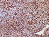 Immunohistochemistry of paraffinembedded Human anaplastic large cell lymphoma with ALK Monoclonal Antibody(Antigen repaired by EDTA).