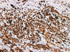 Immunohistochemistry of paraffinembedded Human melanoma tissue with Melan-A Monoclonal Antibody(Antigen repaired by EDTA).